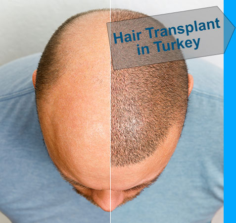 Head balding hair transplant before after