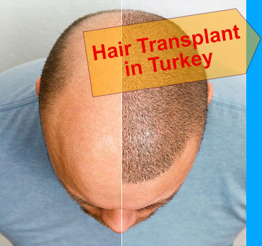 Head balding hair transplant before after