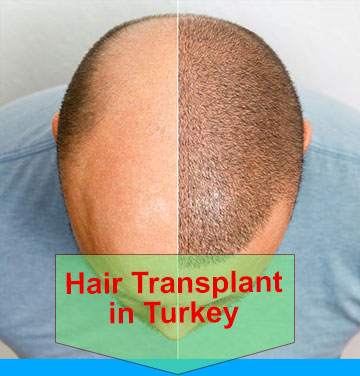 Head balding hair transplant before after