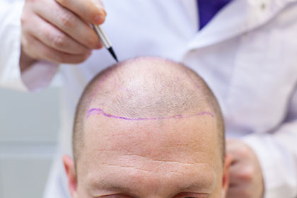 Hair transplant